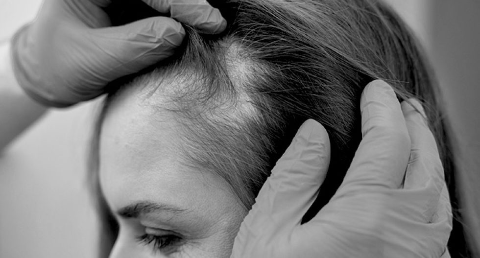 Alopecia: cos’è, cause e trattamenti